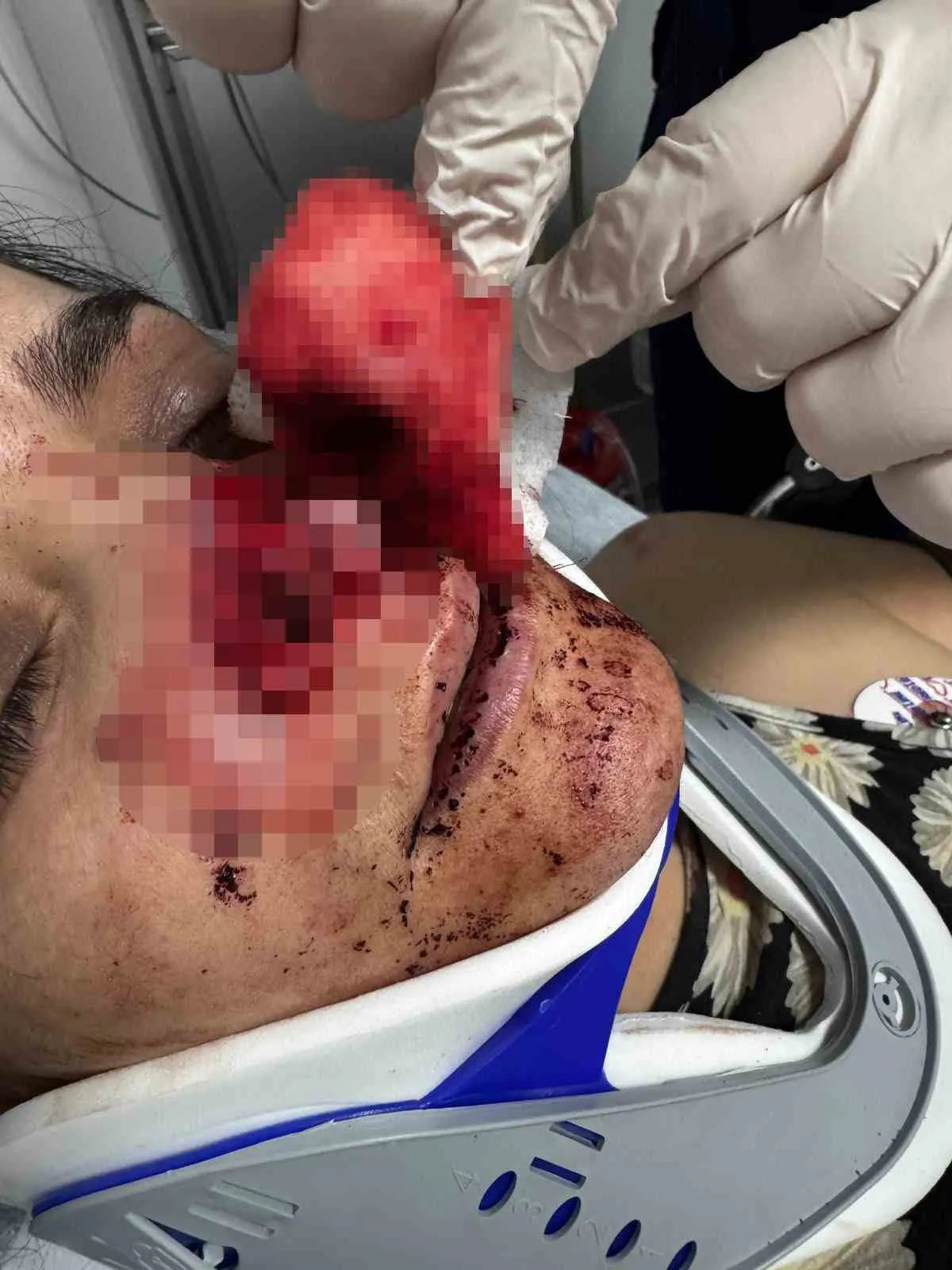 Kabus dolu geceyi anlattı: Eşinin kopardığı burun için mucizevi kurtuluş